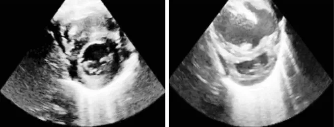 Two black and white ultrasound images of infant hearts, shown side by side. The infant on the left has a healthy heart, the infant on the right has a heart problem.