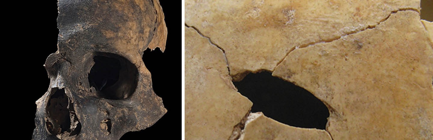 On the left, an image of the left side of a human skull, including the whole nose and mouth region, against a black background. On the right, a close-up of a sheet of bone with a puncture wound mark in it.