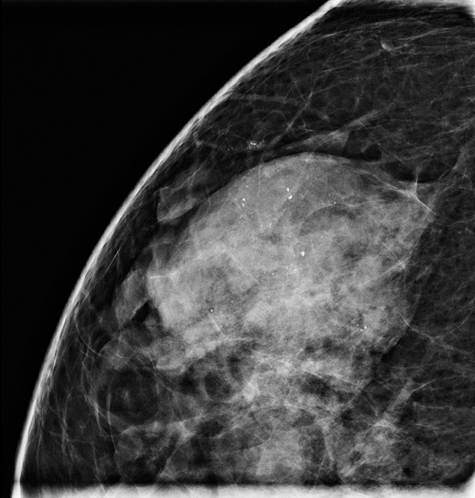 A mammogram of a breast with dense tissue and ductal carcinoma in situ, also called Stage 0 breast cancer. The DCIS appears as small white flecks.