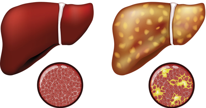 A red illustrated liver is shown next to an illustrated liver with yellow spots all over it
