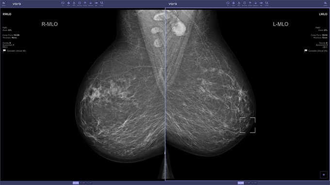 X-ray images of a person's breasts as viewed through an AI-enabled image viewer. A white square highlights a region in one image that the AI suspects might be cancerous.