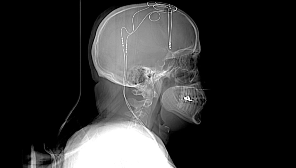 brain implants for depression X-ray