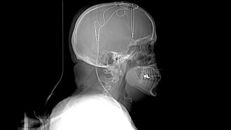 brain implants for depression X-ray