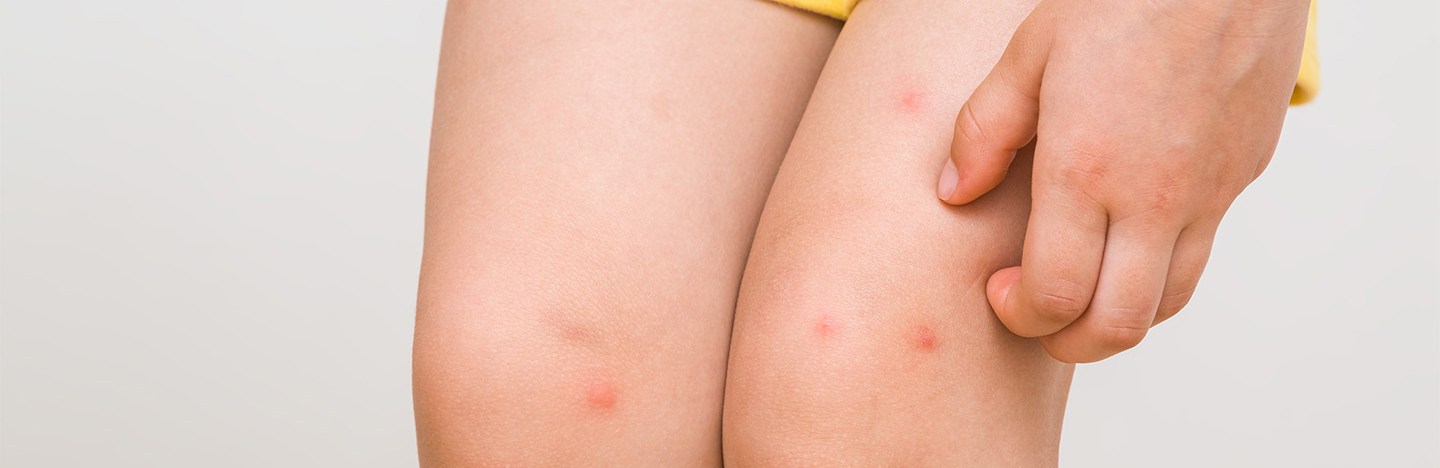 A child's legs have multiple itchy-looking red bug bites that are being scratched.