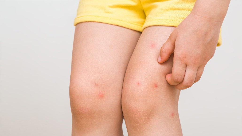 A child's legs have multiple itchy-looking red bug bites that are being scratched.