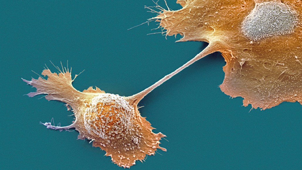 A scanning electron microscope image of a pancreatic cancer cell that shows intricate details of the cell’s membrane, with a textured appearance, spiky protrusions and a connecting bridge between cells.