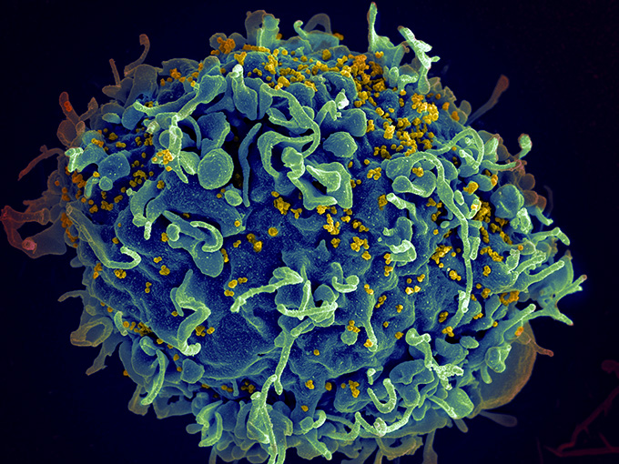 This microscopy picture shows a big blue cell being attacked by HIV, which shows up as little yellow dots on the surface.