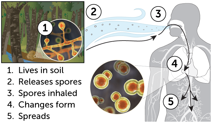 A diagram showing how a fungus that's normally found in soil releases spores that are then inhaled. At that point, the fungus changes shape, as seen in a pull-out image, and can then spread.