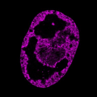 A cell's DNA (shown in purple) is getting compacted and now large black gaps show up just three hours after an infection with the herpesvirus. This is the third of four images in a slideshow.