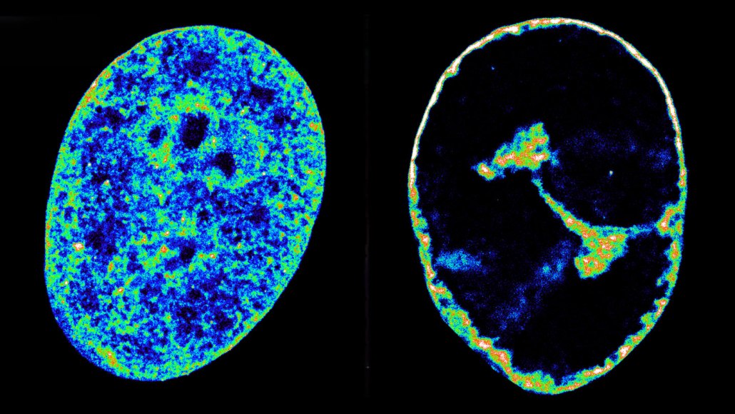 This side-by-side image shows an uninfected cell (left) with its innards spread throughout the cell, and one infected by the herpesvirus (right). The cell's insides are now compacted into a small area in the center of the cell.