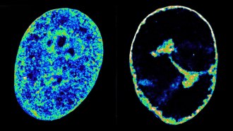 This side-by-side image shows an uninfected cell (left) with its innards spread throughout the cell, and one infected by the herpesvirus (right). The cell's insides are now compacted into a small area in the center of the cell.