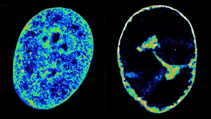 This side-by-side image shows an uninfected cell (left) with its innards spread throughout the cell, and one infected by the herpesvirus (right). The cell's insides are now compacted into a small area in the center of the cell.