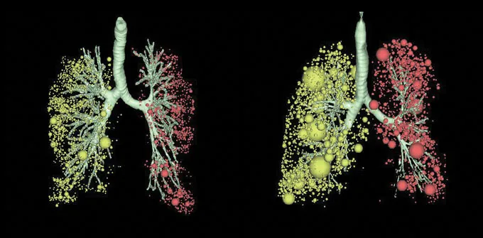 A 3-D image of two pairs of lungs