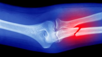 X-ray of an arm bone showing a fracture near the elbow joint, highlighted in red to emphasize the break.
