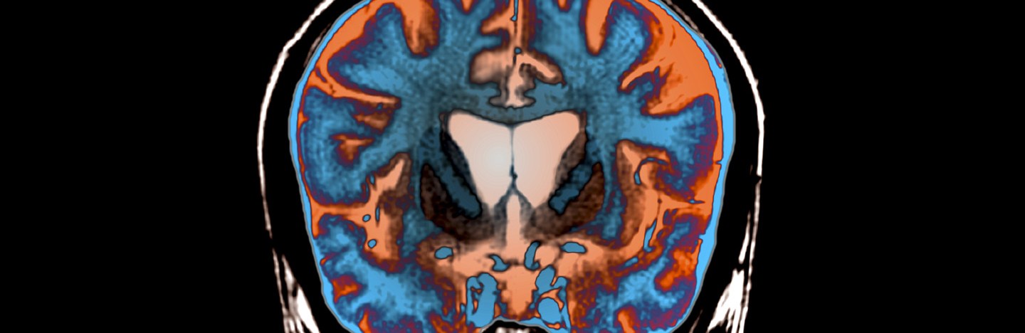 An MRI image of the brain of a person with Huntington's disease. The brain shows up in blue and orange and the outline of the skull and some other bones are visible.