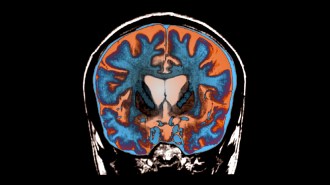 An MRI image of the brain of a person with Huntington's disease. The brain shows up in blue and orange and the outline of the skull and some other bones are visible.