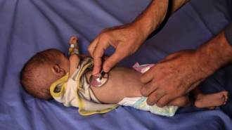 A young child suffering from malnutrition is examined in a hospital in Gaza.