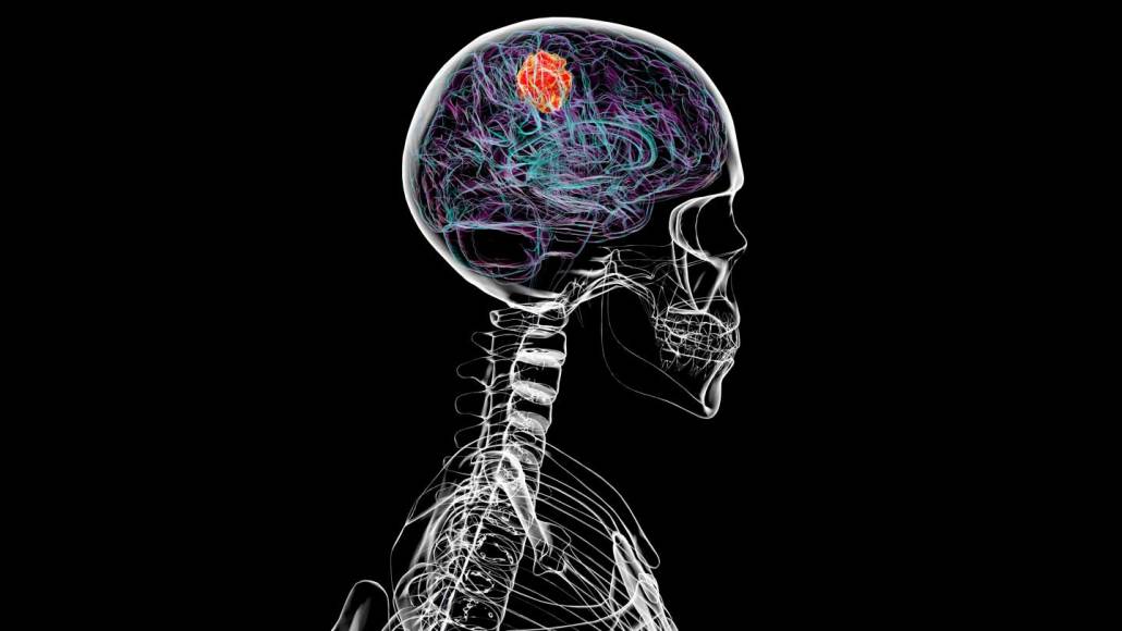 An illustration over an X-ray image shows a human head and neck from the side, with red and blue lines indicating the presence of glioblastoma in a person