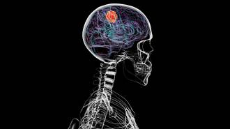 An illustration over an X-ray image shows a human head and neck from the side, with red and blue lines indicating the presence of glioblastoma in a person