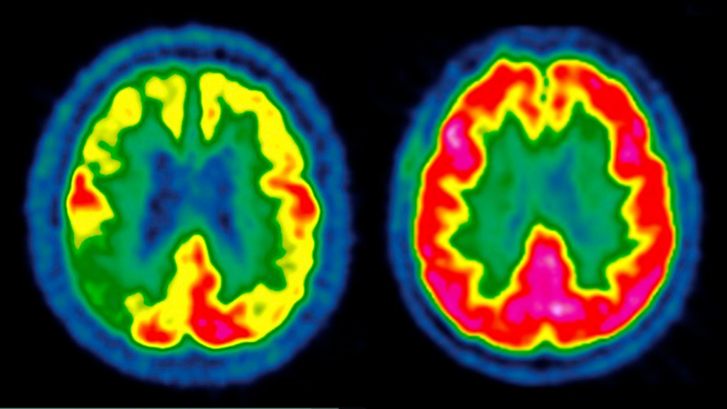 Two brain scans shown side by side with highlights in primary colors, against a black background. The left scan has more blue and green, while the right scan has more higlighted in red.
