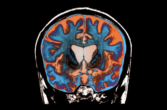 An image of a brain inside a skull is on a black background.