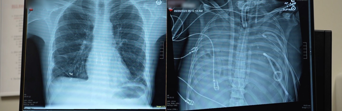 Two X-rays side by side show a man's new lungs and his old ones, which wew so damaged they could not hold air.