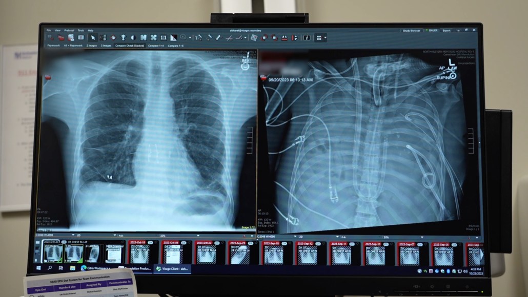 Two X-rays side by side show a man's new lungs and his old ones, which wew so damaged they could not hold air.