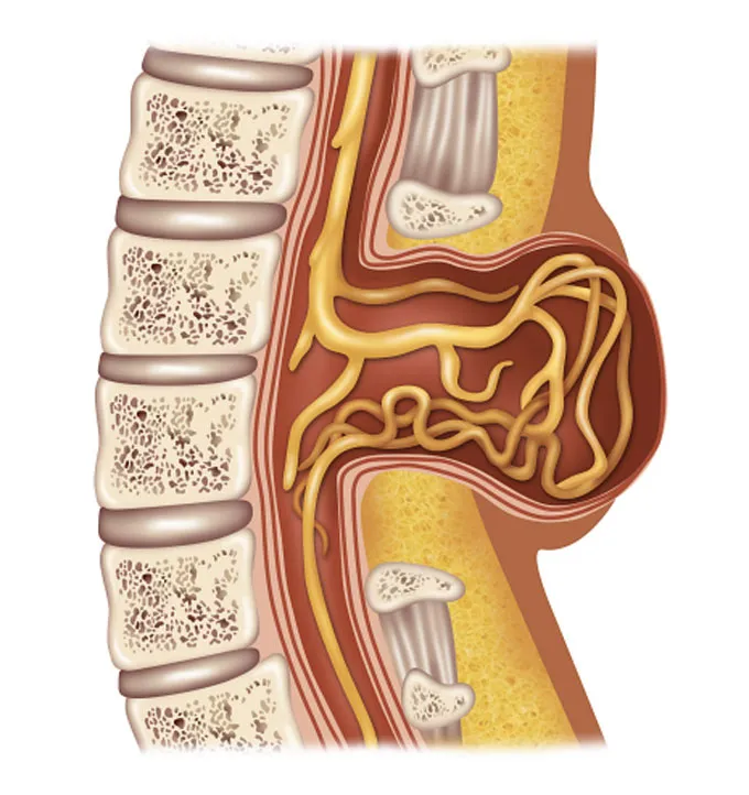 An illustration of spina bifida.