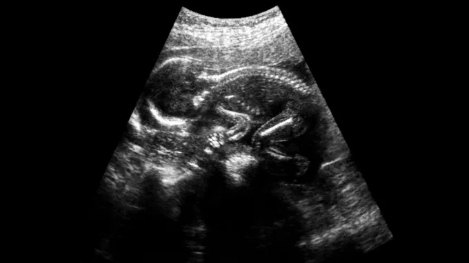 A black-and-white ultrasound image of a baby in the womb.