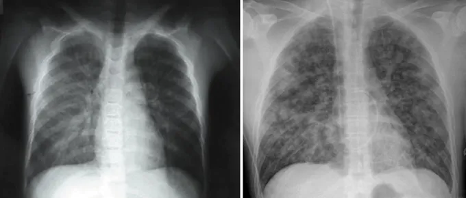 Two X-ray images of people with Andes hantavirus infections. On the left the lungs are mostly dark with some slight hazing where fluid has seeped into small airways. On the right, both lungs are full of cottony fluid-filled airways.
