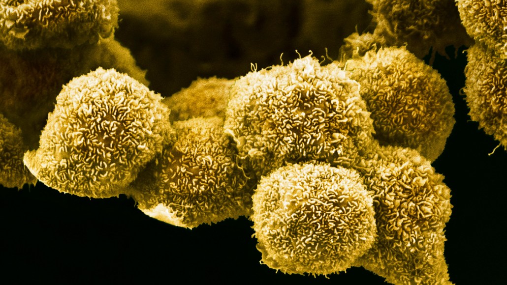 A microscopy image of yellow, textured pancreatic cancer cells.