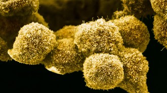 A microscopy image of yellow, textured pancreatic cancer cells.