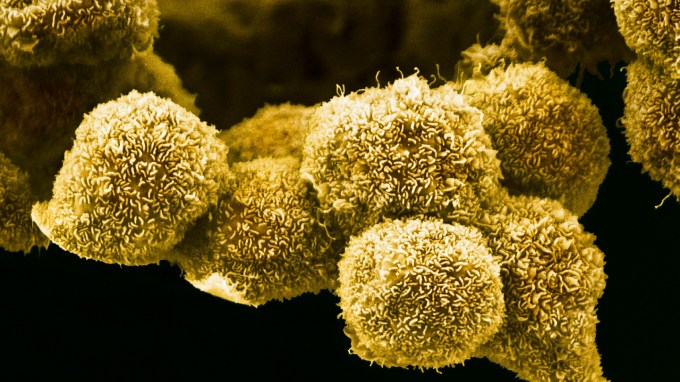 A microscopy image of yellow, textured pancreatic cancer cells.
