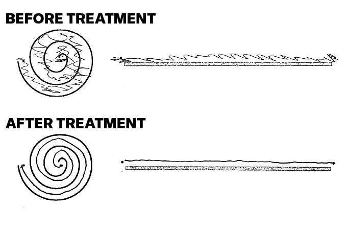 An illustration of how patients were able to draw before being administered high-intensity focused ultrasound treatment, which are mostly shaky lines; and how patients drew after, which are mostly straight lines.