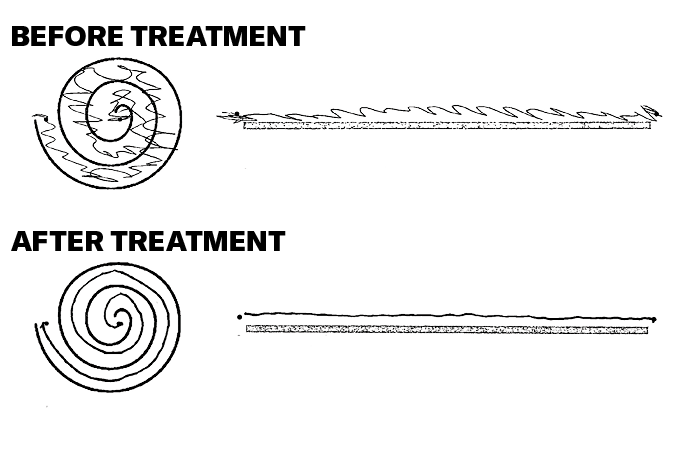 An illustration of how patients were able to draw before being administered high-intensity focused ultrasound treatment, which are mostly shaky lines; and how patients drew after, which are mostly straight lines.