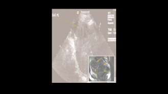 Ultrasound showing uterine fibroids (dark areas marked with arrows), with a magnetic resonance image providing additional information (inset).