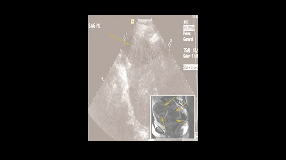Ultrasound showing uterine fibroids (dark areas marked with arrows), with a magnetic resonance image providing additional information (inset).