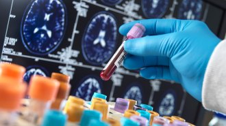 A vial of blood and brain scans for dementia in the background