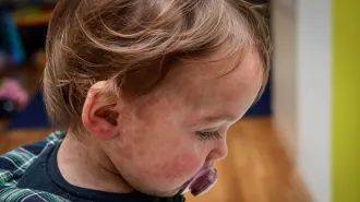 a child with a red, blotchy rash on the right side of their face, a symptom of measles, sucks on a pacifier