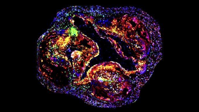 A cross section of a mouse's aorta is seen on a black background. The center, instead of being clear, is largely blocked by lumpy plaques. Red sections show areas where there are an influx of immune cells and green show where those cells are releasing anti-inflammatory proteins.