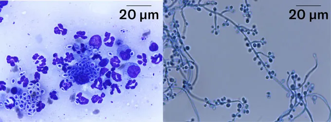 Two microscope images of the fungus Sporothrix brasiliensis. On the left is an image of human cells and the yeast form of the fungus both stained blue/purple. On the right is an image of the hyphal form which looks like a long string with small grape-like spheres growing off it.