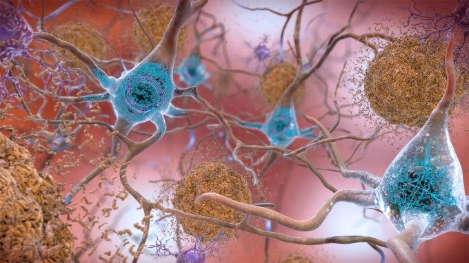 An illustration shows blue hubs filled with threadlike squiggles to denote tau in the brain. Fuzzy brown orbs represent amyloid plaques. Both are hallmarks of Alzheimer's disease.