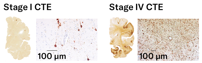 This diagram shows two slices of brain from people diaganosed with different stages of CTE. A close-up of the one on the left at Stage I shows some dark dots that are signs of the protein tau. The one on the left at Stage IV shows the entire sample speckled with tau.