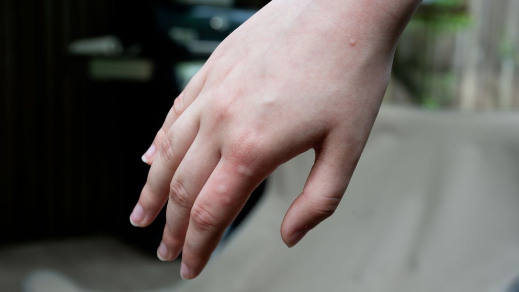 The back of a hand inflamed with multiple mosquito bites
