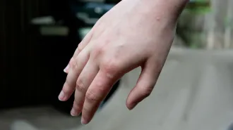 The back of a hand inflamed with multiple mosquito bites