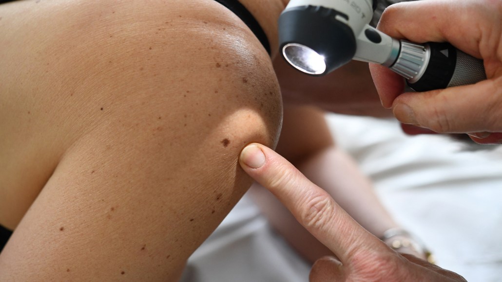 a person's knee is shown close up. a medical professional is pointing to a freckle on the knee while examining it with a medical flashlight held in their other hand.