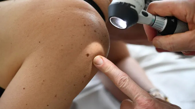 a person's knee is shown close up. a medical professional is pointing to a freckle on the knee while examining it with a medical flashlight held in their other hand.